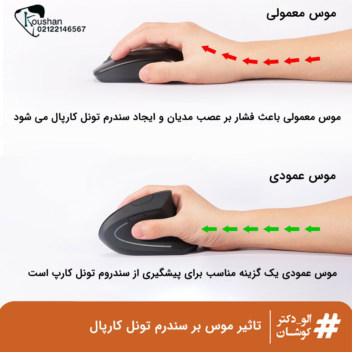 تاثیر موس بر سندروم تونل کارپال