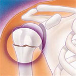 • شکستگی قسمت بالایی استخوان بازو