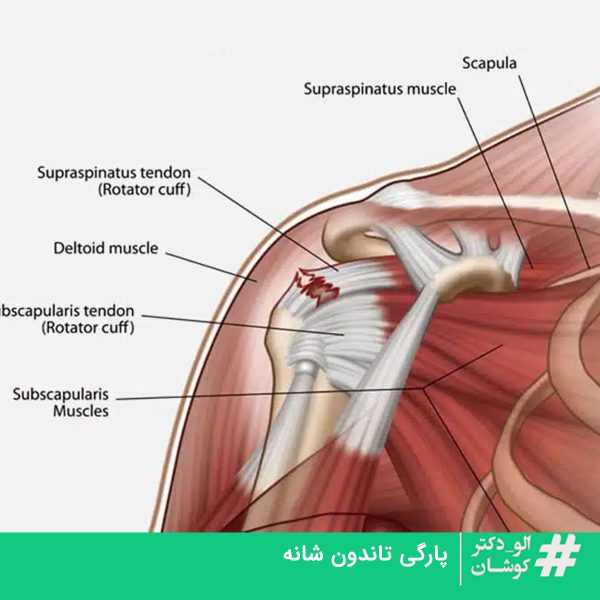 پارگی تاندون شانه