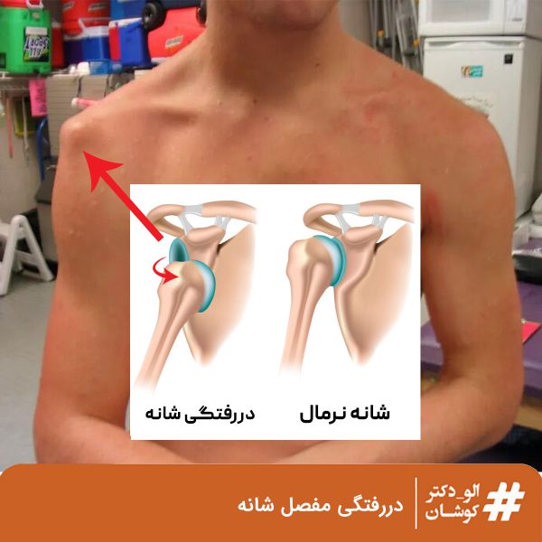 دررفتگی مفصل شانه