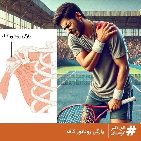 پارگی روتاتور کاف