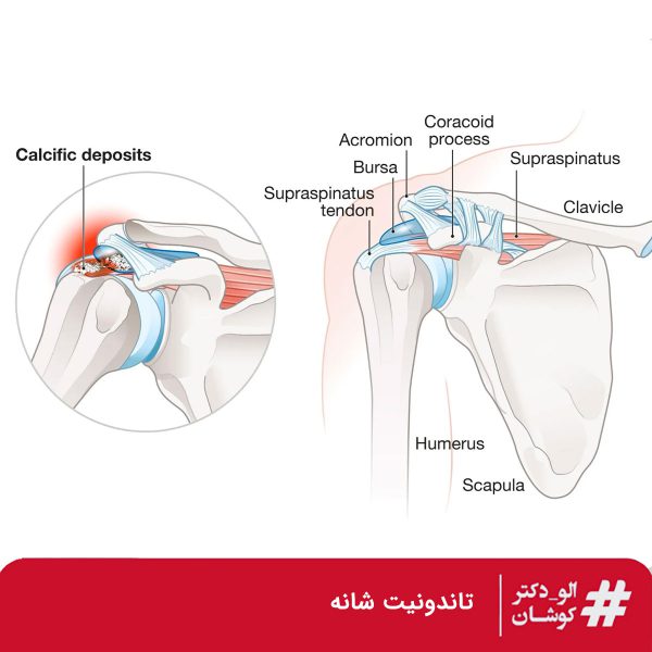 تاندونیت شانه
