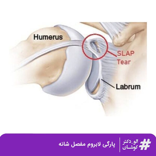 پارگی لابروم مفصل شانه