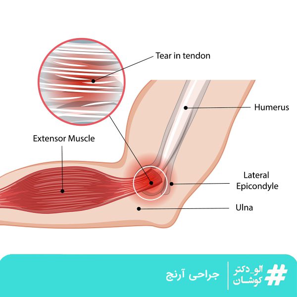 جراحی آرنج