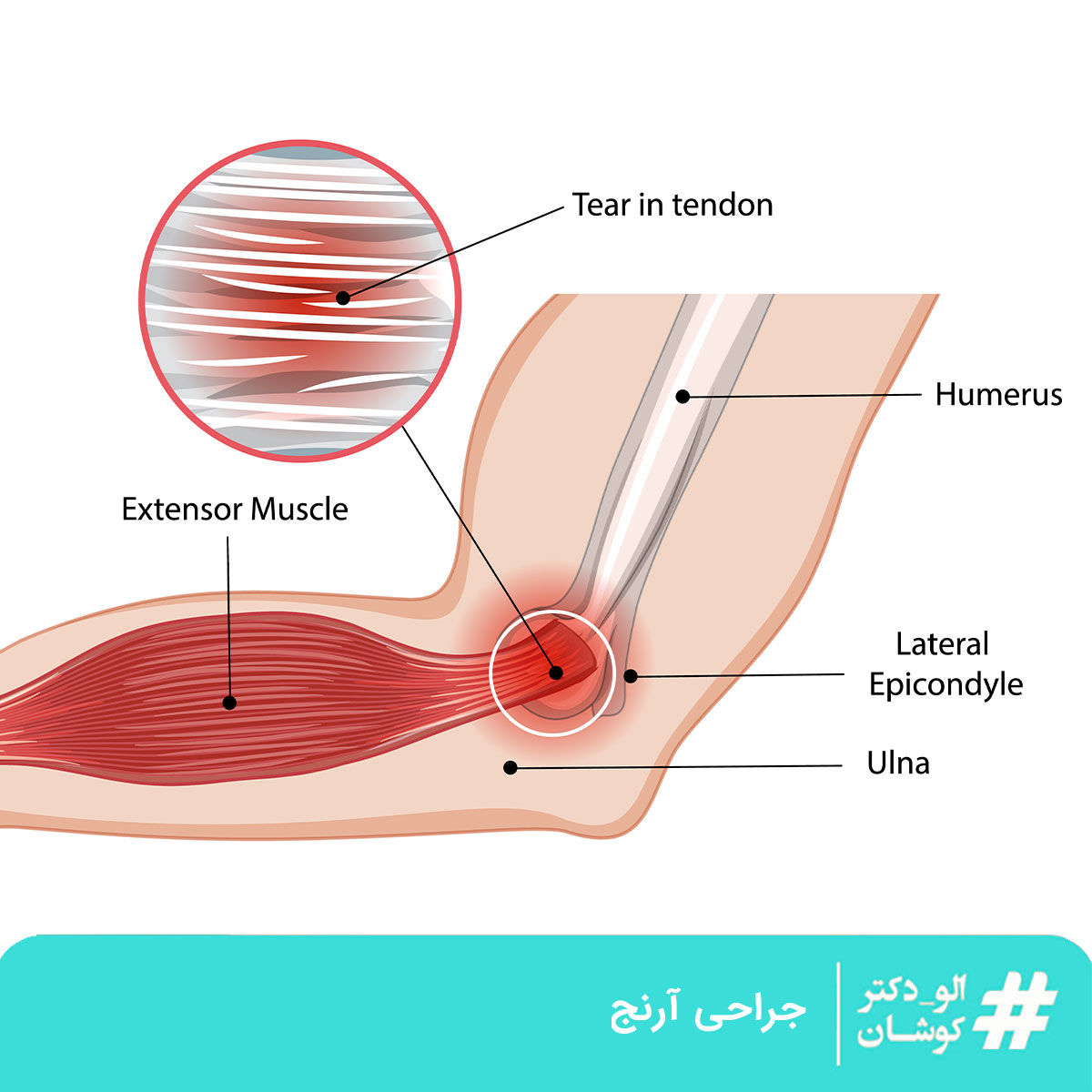 جراحی آرنج