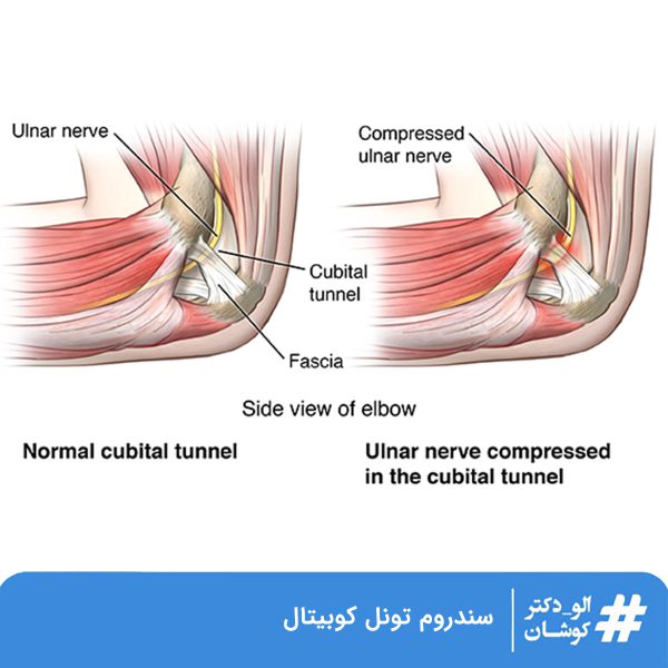سندروم تونل کوبیتال