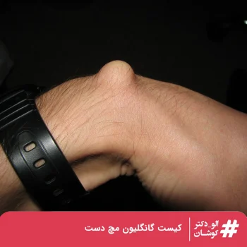 برآمدگی کیست گانگلیون در پشت مچ دست