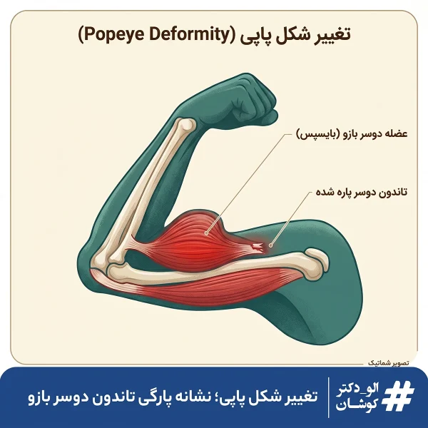 تغییر شکل پاپی نشانه پارگی تاندون دو سر بازو